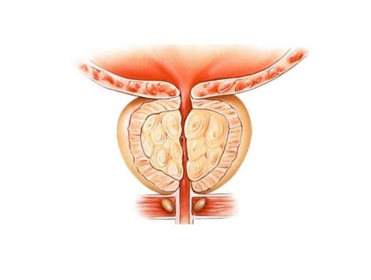 An increase in prostate with prostatitis