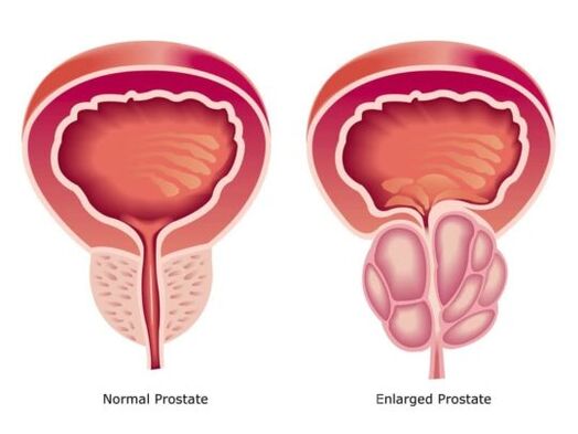 Prostate is normal and enlarged